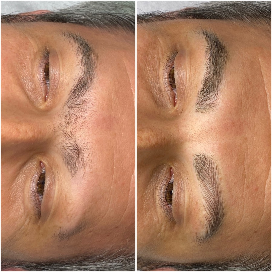 Reconstrucție sprâncene fir cu fir după chimioterapie sau alopecie